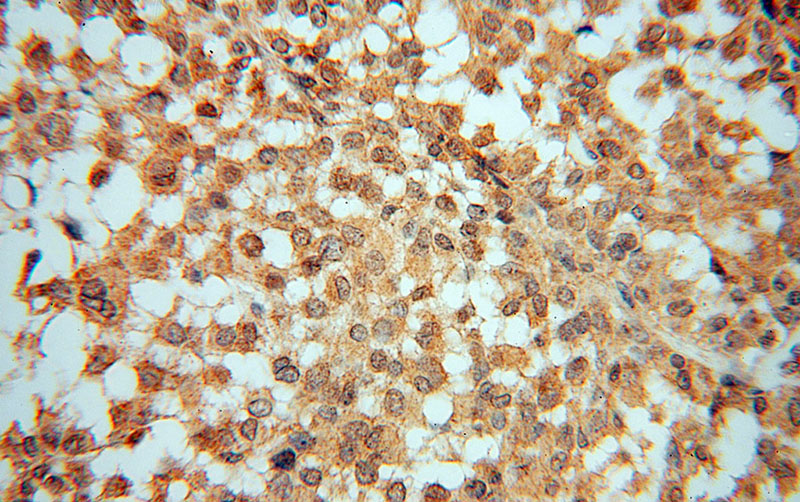 Immunohistochemical of paraffin-embedded human breast cancer using Catalog No:116520(UBE2D4 antibody) at dilution of 1:50 (under 40x lens)