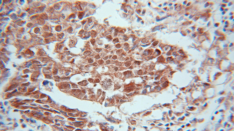 Immunohistochemical of paraffin-embedded human ovary tumor using Catalog No:108818(CALCocO2 antibody) at dilution of 1:100 (under 10x lens)
