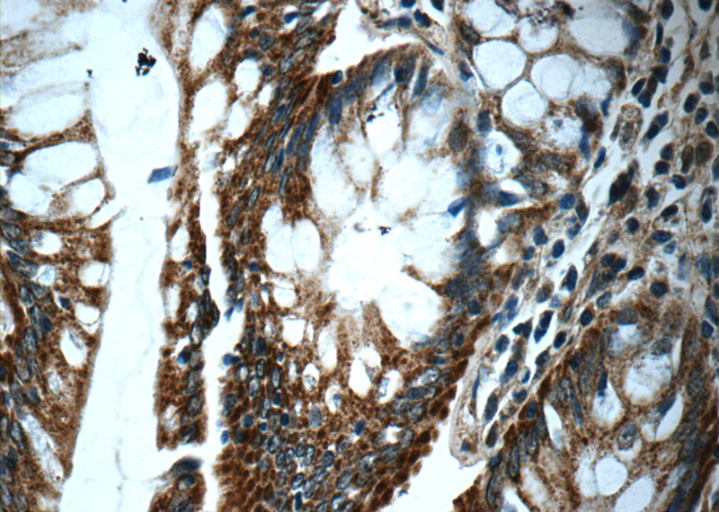 Immunohistochemistry of paraffin-embedded human colon tissue slide using Catalog No:116818(WDR92 Antibody) at dilution of 1:50 (under 40x lens)