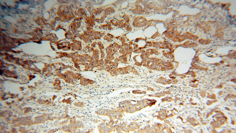 Immunohistochemical of paraffin-embedded human prostate cancer using Catalog No:114733(RND2 antibody) at dilution of 1:50 (under 10x lens)