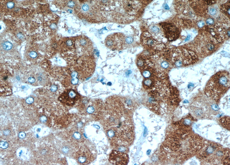 Immunohistochemical of paraffin-embedded human hepatocirrhosis using Catalog No:110580(FAM185A antibody) at dilution of 1:50 (under 40x lens)