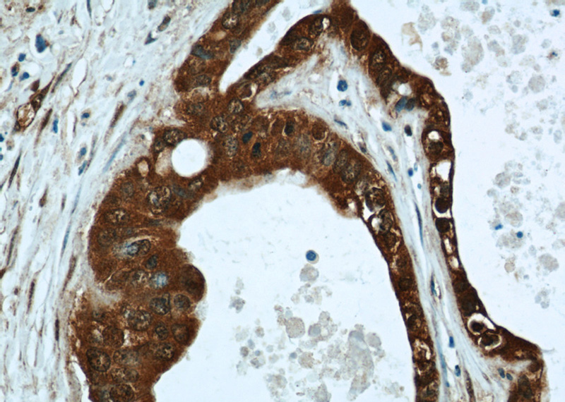 Immunohistochemical of paraffin-embedded human liver cancer using Catalog No:112227(LIMD2 antibody) at dilution of 1:50 (under 40x lens)