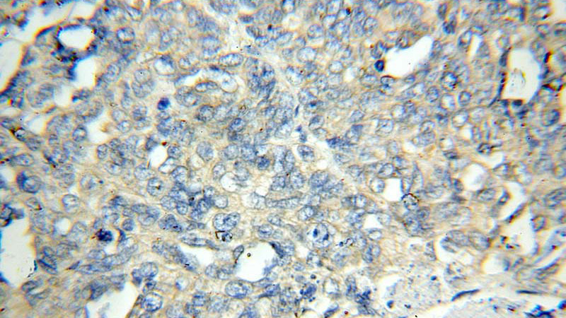 Immunohistochemical of paraffin-embedded human ovary tumor using Catalog No:110686(FLCN antibody) at dilution of 1:50 (under 40x lens)