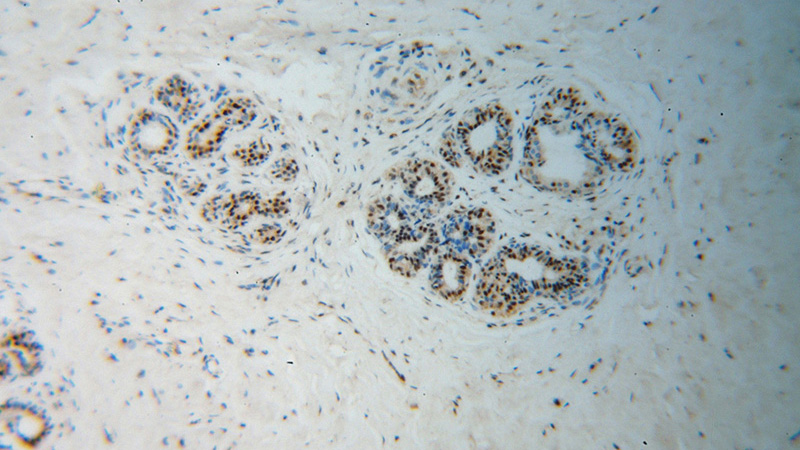 Immunohistochemical of paraffin-embedded human breast cancer using Catalog No:114043(POLR2H antibody) at dilution of 1:100 (under 10x lens)