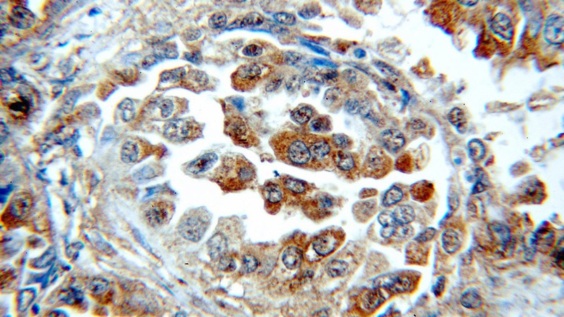 Immunohistochemical of paraffin-embedded human lung cancer using Catalog No:107512(RRM1 antibody) at dilution of 1:100 (under 40x lens)