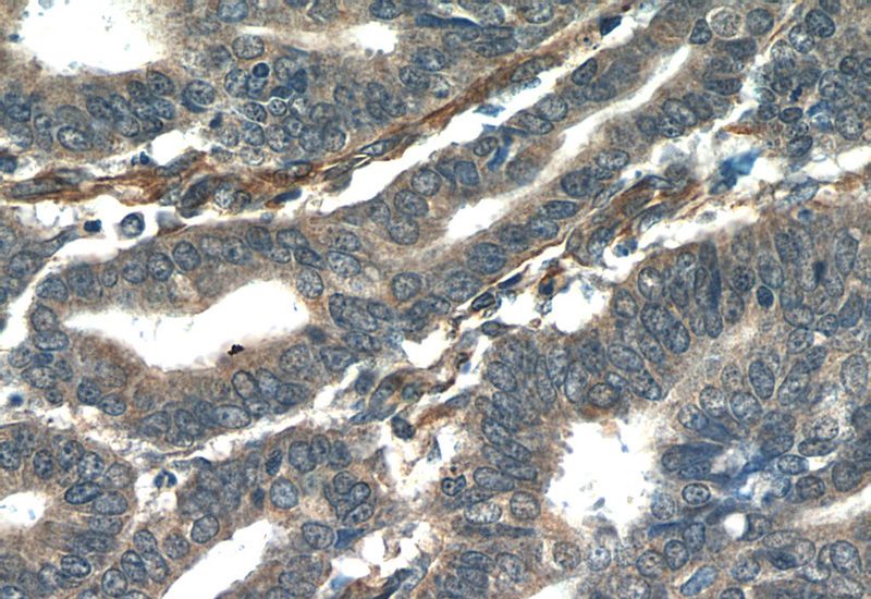 Immunohistochemistry of paraffin-embedded human endometrial cancer tissue slide using Catalog No:113418(ORAI3 Antibody) at dilution of 1:50 (under 40x lens)