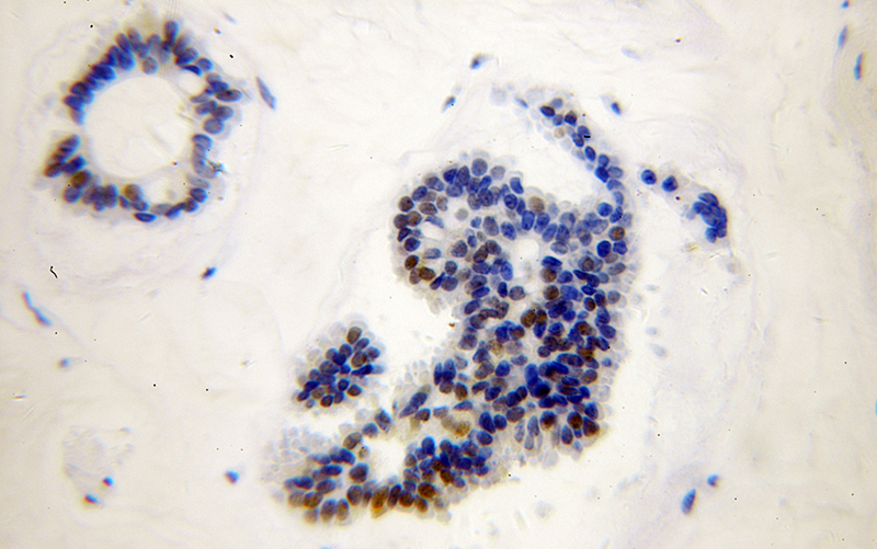 Immunohistochemical of paraffin-embedded human breast cancer using Catalog No:114510(RAD17 antibody) at dilution of 1:100 (under 40x lens)
