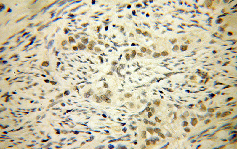 Immunohistochemical of paraffin-embedded human endometrial cancer using Catalog No:112176(LCOR antibody) at dilution of 1:50 (under 40x lens)