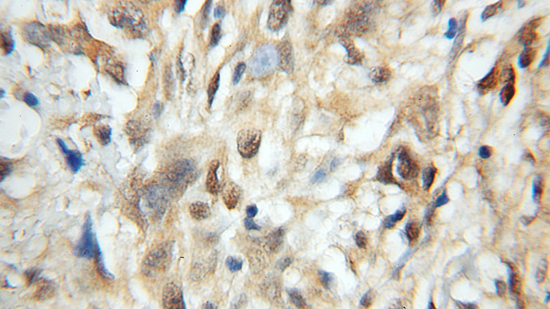 Immunohistochemical of paraffin-embedded human gliomas using Catalog No:112803(MRFAP1 antibody) at dilution of 1:50 (under 10x lens)