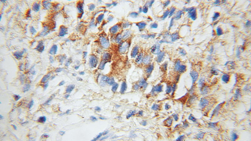 Immunohistochemical of paraffin-embedded human prostate cancer using Catalog No:116518(UBE2D1 antibody) at dilution of 1:50 (under 10x lens)
