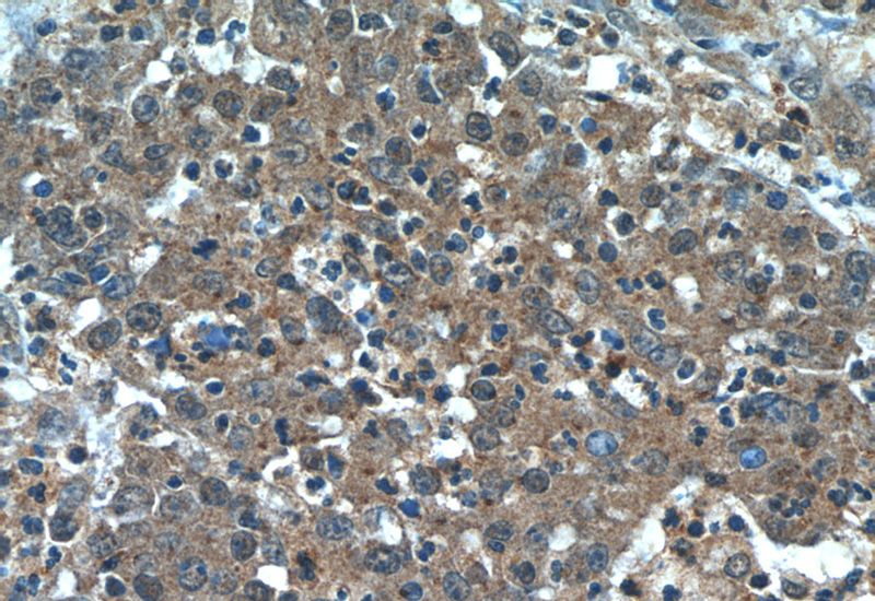 Immunohistochemistry of paraffin-embedded human colon cancer tissue slide using Catalog No:107639(TAGLN2 Antibody) at dilution of 1:50 (under 40x lens)