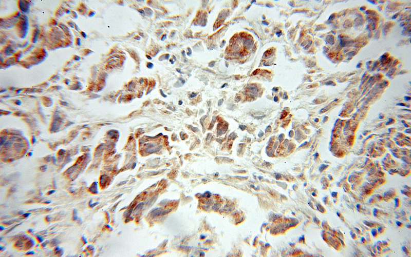Immunohistochemical of paraffin-embedded human prostate cancer using Catalog No:115266(SHC1 antibody) at dilution of 1:50 (under 10x lens)