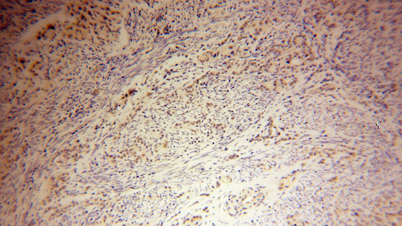 Immunohistochemical of paraffin-embedded human endometrial cancer using Catalog No:112176(LCOR antibody) at dilution of 1:50 (under 10x lens)