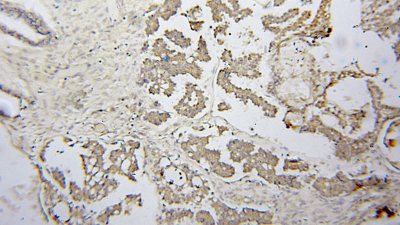 Immunohistochemical of paraffin-embedded human ovary tumor using Catalog No:116716(VARS2 antibody) at dilution of 1:100 (under 10x lens)