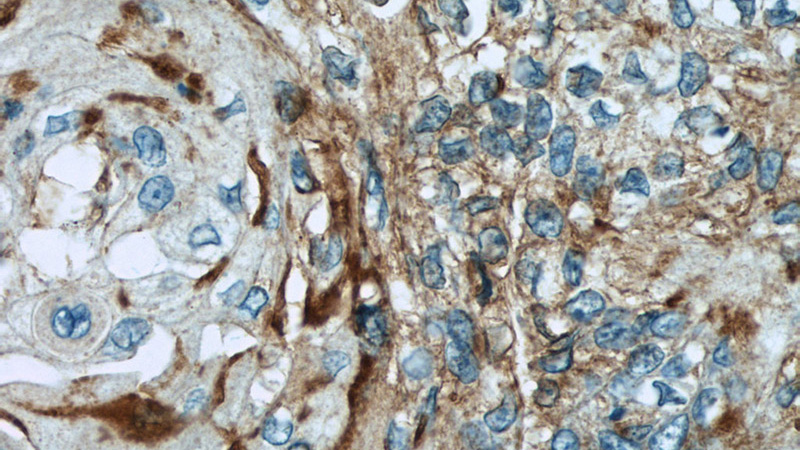 Immunohistochemical of paraffin-embedded human oesophagus cancer using Catalog No:109235(CHMP4B antibody) at dilution of 1:50 (under 40x lens)