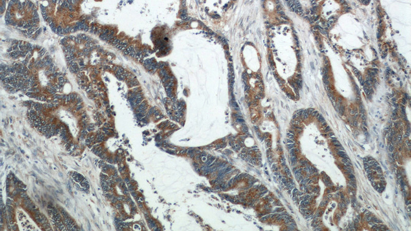 Immunohistochemical of paraffin-embedded human colon cancer using Catalog No:112767(COX2 antibody) at dilution of 1:50 (under 10x lens)