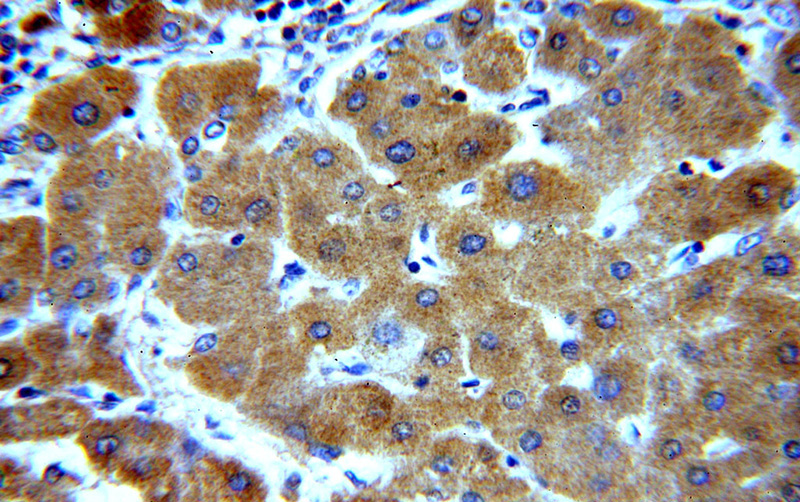 Immunohistochemical of paraffin-embedded human hepatocirrhosis using Catalog No:116475(UBASH3B antibody) at dilution of 1:100 (under 40x lens)