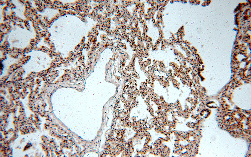 Immunohistochemical of paraffin-embedded human lung using Catalog No:111866(ITGB6-Specific antibody) at dilution of 1:100 (under 10x lens)