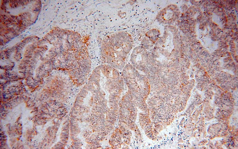 Immunohistochemical of paraffin-embedded human ovary tumor using Catalog No:112021(KCTD5 antibody) at dilution of 1:50 (under 10x lens)