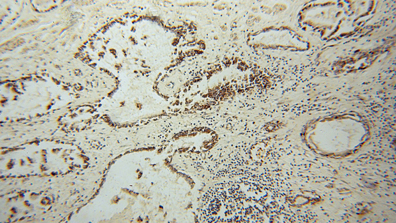 Immunohistochemical of paraffin-embedded human prostate cancer using Catalog No:111555(HSDL2 antibody) at dilution of 1:100 (under 10x lens)
