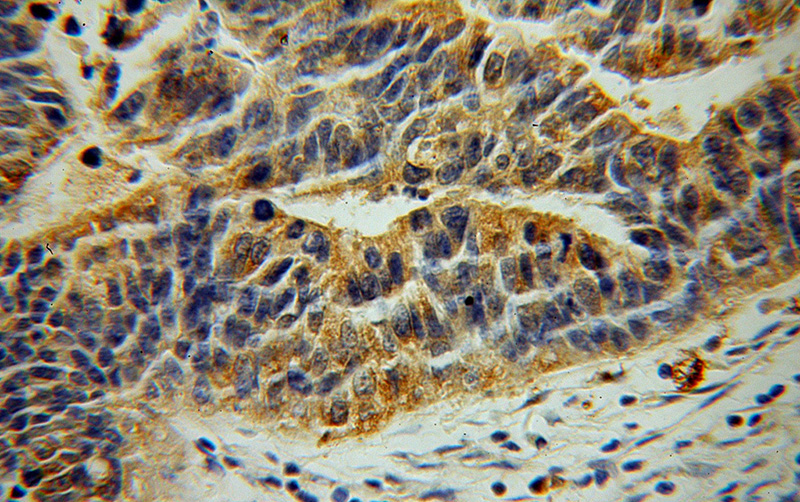 Immunohistochemical of paraffin-embedded human osteosarcoma using Catalog No:112187(LDHD antibody) at dilution of 1:50 (under 40x lens)
