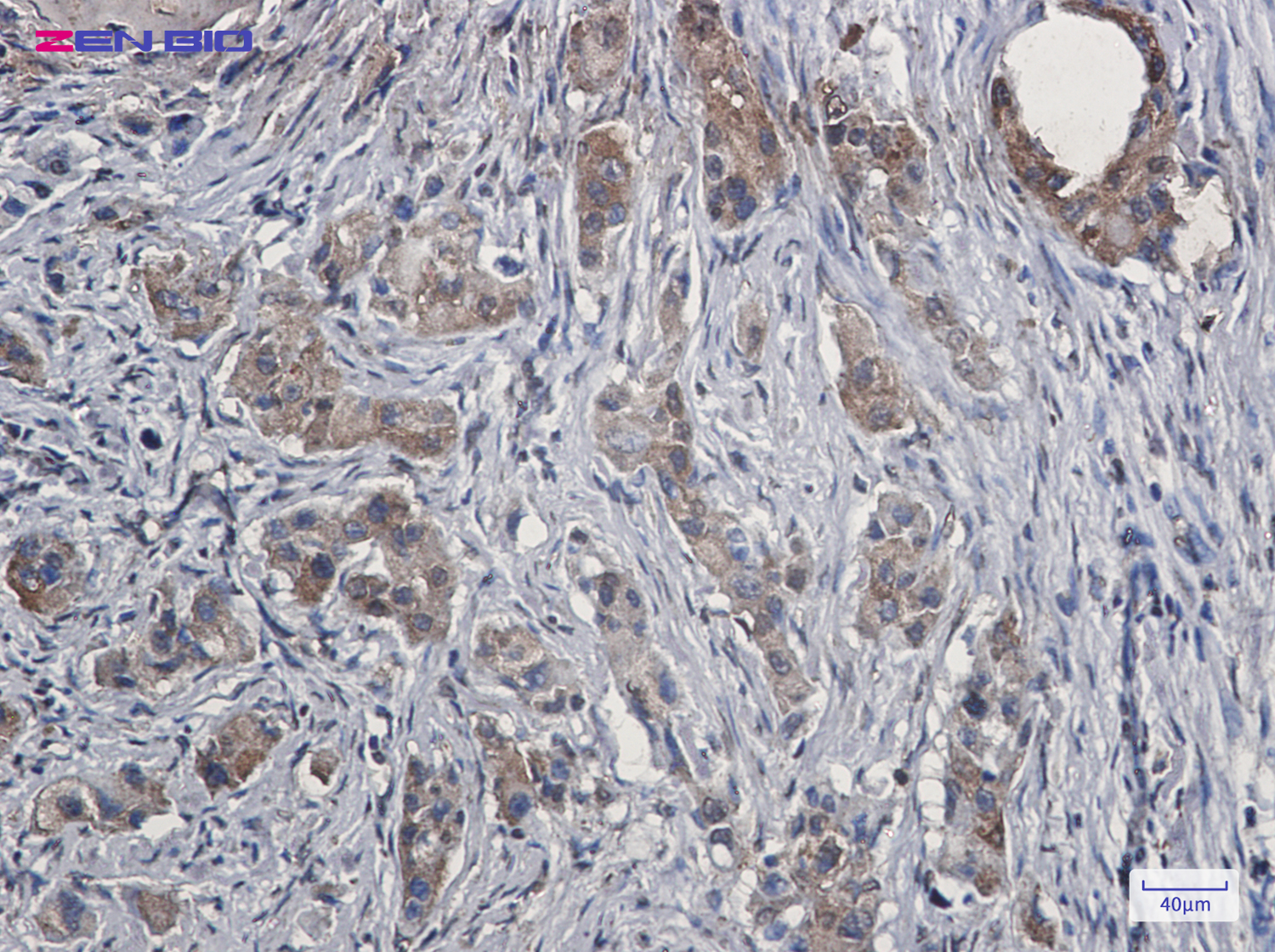 Immunohistochemistry of Ezrin in paraffin-embedded Human lung cancer tissue using Ezrin Rabbit pAb at dilution 1/20