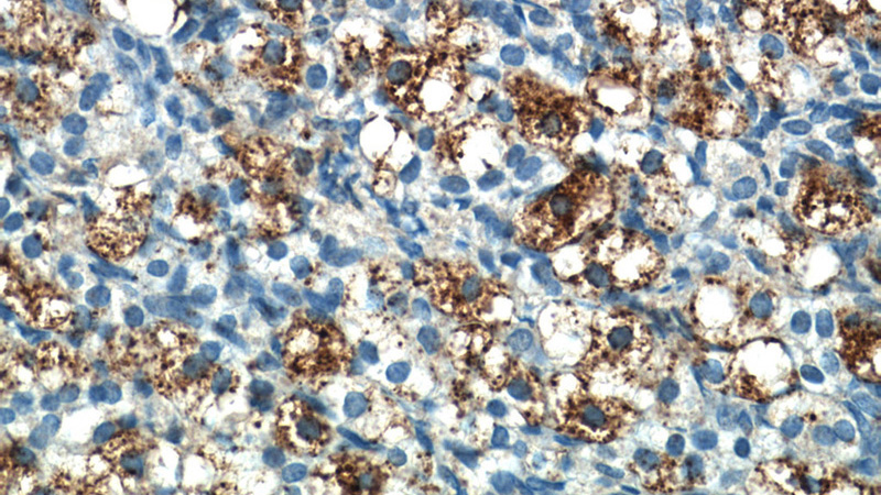 Immunohistochemistry of paraffin-embedded human ovary tissue slide using Catalog No:113930(PLAC1L Antibody) at dilution of 1:50 (under 40x lens)
