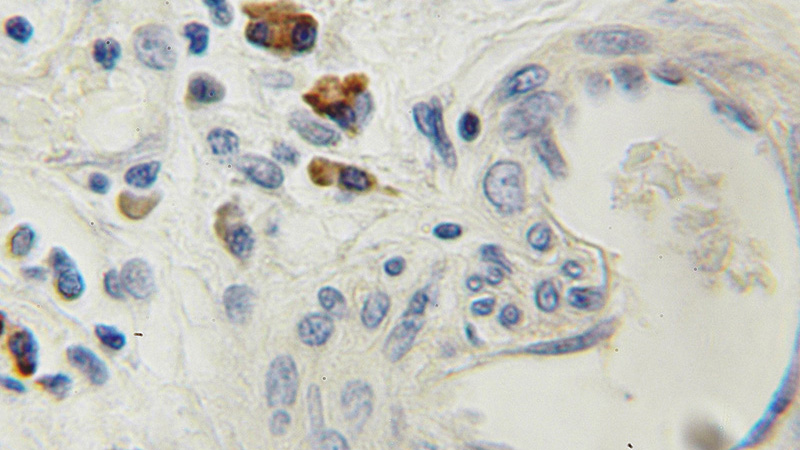 Immunohistochemical of paraffin-embedded human prostate cancer using Catalog No:116328(TRAM1 antibody) at dilution of 1:50 (under 10x lens)