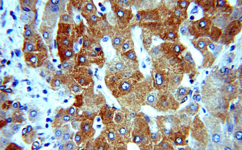 Immunohistochemical of paraffin-embedded human hepatocirrhosis using Catalog No:109908(DGUOK antibody) at dilution of 1:100 (under 40x lens)