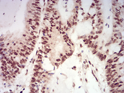 Fig4: Immunohistochemical analysis of paraffin-embedded human colon cancer tissue using anti-XRN2 antibody. Counter stained with hematoxylin.