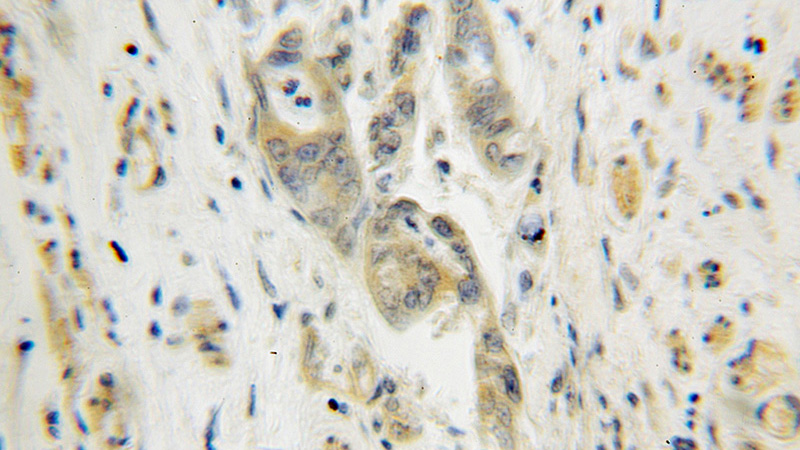 Immunohistochemical of paraffin-embedded human colon cancer using Catalog No:112673(MLF1 antibody) at dilution of 1:100 (under 10x lens)