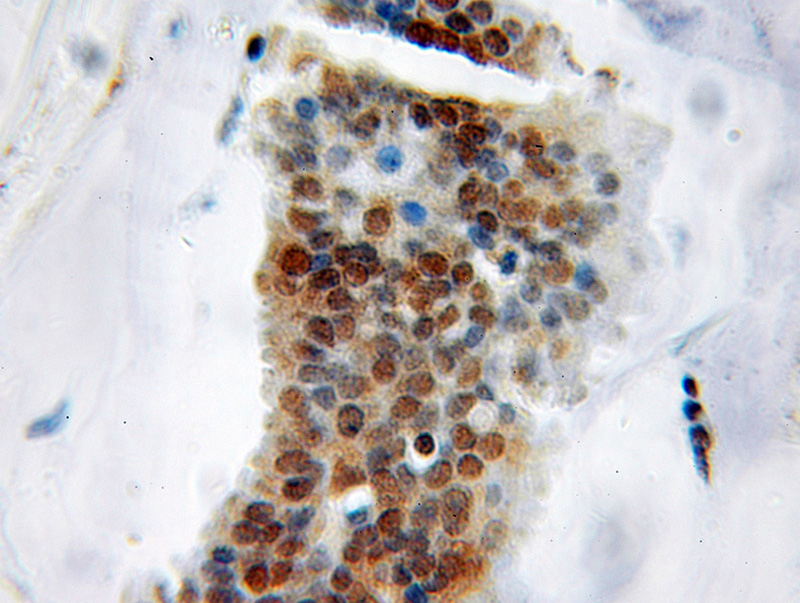Immunohistochemical of paraffin-embedded human breast cancer using Catalog No:115049(KHDRBS1 antibody) at dilution of 1:50 (under 10x lens)