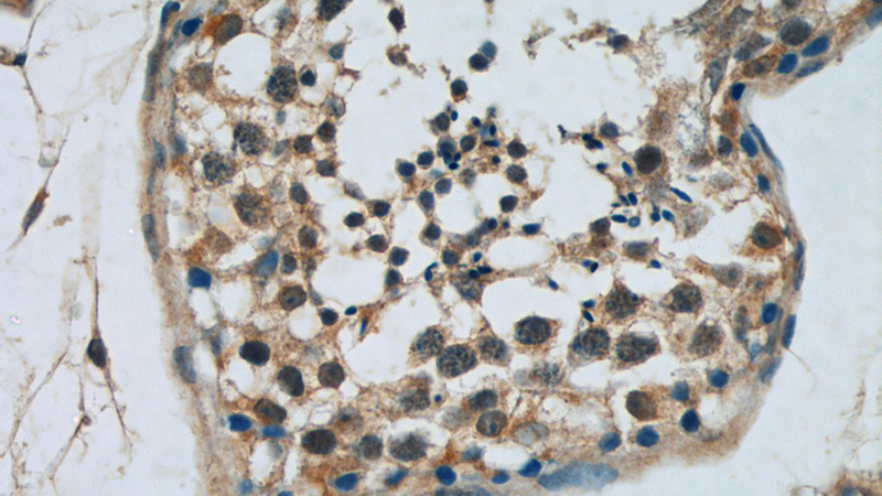 Immunohistochemistry of paraffin-embedded human testis tissue slide using Catalog No:108372(BBS5 Antibody) at dilution of 1:50 (under 40x lens)