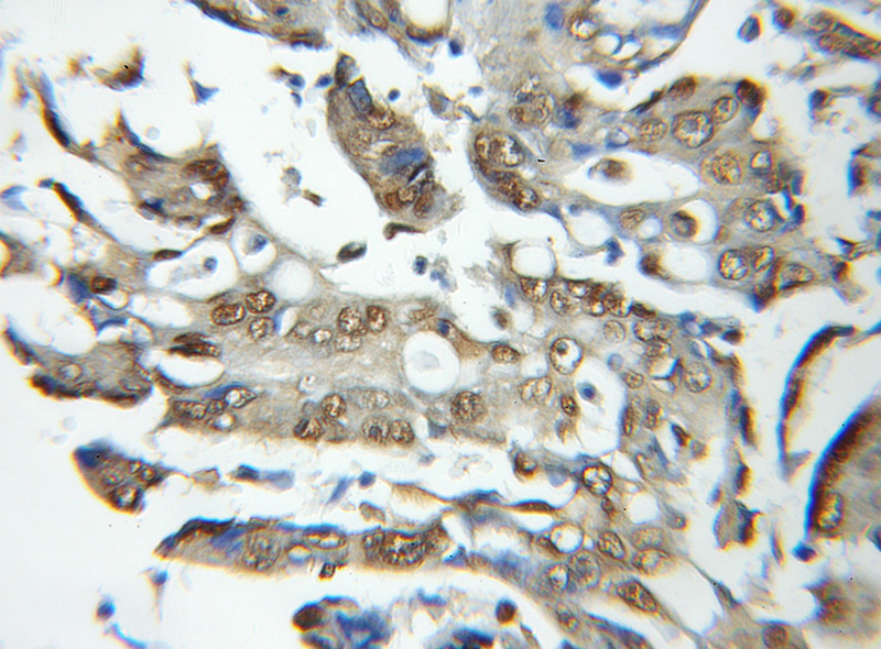 Immunohistochemical of paraffin-embedded human colon cancer using Catalog No:114386(PSMB6 antibody) at dilution of 1:50 (under 40x lens)