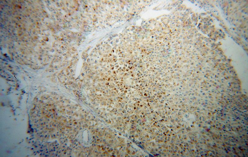 Immunohistochemical of paraffin-embedded human liver cancer using Catalog No:107749(AOX antibody) at dilution of 1:100 (under 10x lens)