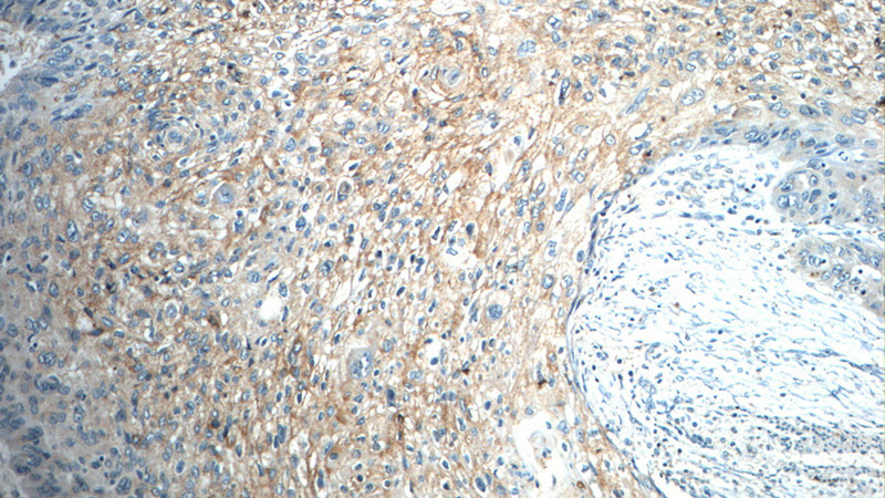 Immunohistochemistry of paraffin-embedded human oesophagus cancer tissue slide using Catalog No:116162(C3orf23 Antibody) at dilution of 1:50 (under 10x lens)