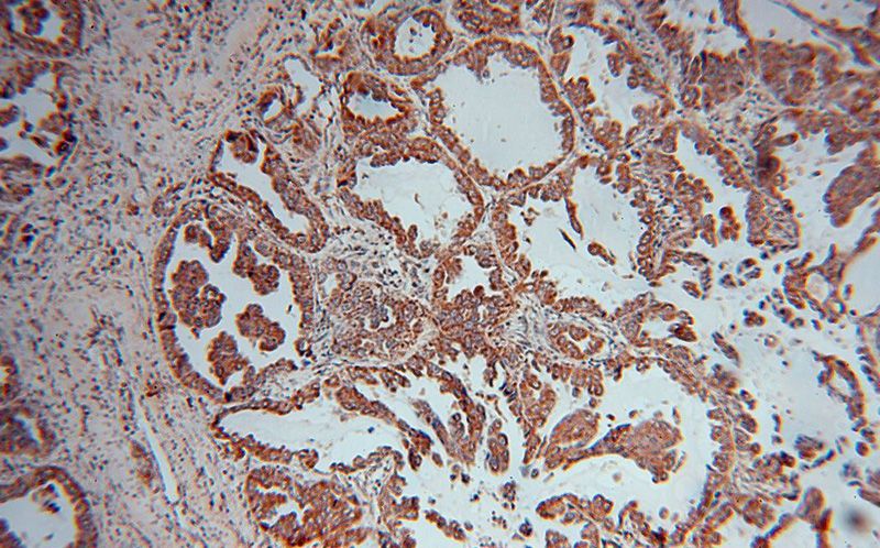 Immunohistochemical of paraffin-embedded human lung cancer using Catalog No:112120(KRAS-2A-specific antibody) at dilution of 1:50 (under 10x lens)