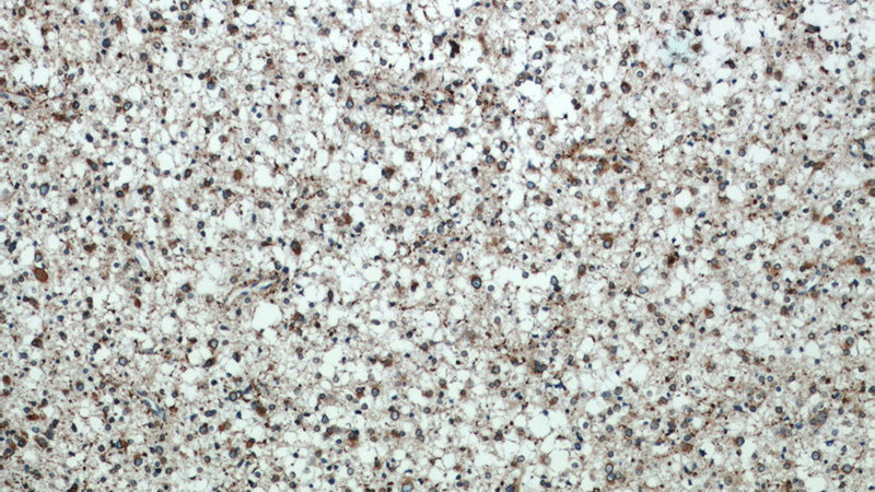 Immunohistochemical of paraffin-embedded human gliomas using Catalog No:112052(KIFAP3 antibody) at dilution of 1:50 (under 10x lens)