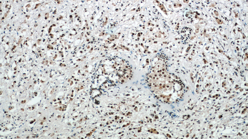 Immunohistochemistry of paraffin-embedded human breast cancer tissue slide using Catalog No:111828(IRAK1 Antibody) at dilution of 1:50 (under 10x lens)