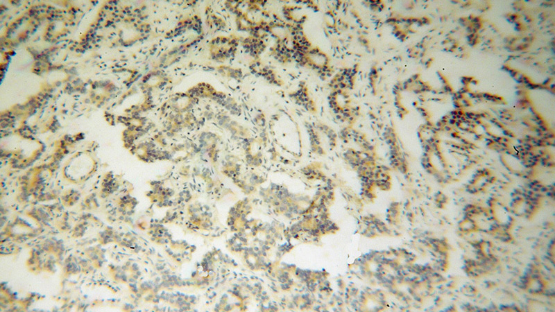 Immunohistochemical of paraffin-embedded human gliomas using Catalog No:114064(SH3RF1 antibody) at dilution of 1:100 (under 10x lens)