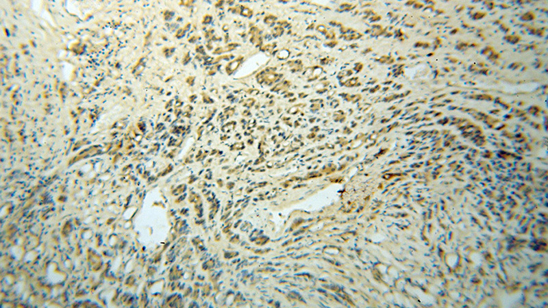 Immunohistochemical of paraffin-embedded human gliomas using Catalog No:112164(LC3 antibody) at dilution of 1:50 (under 10x lens)