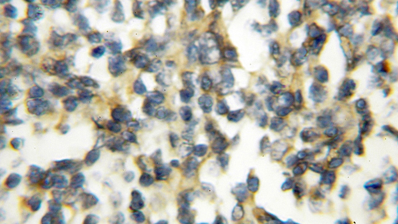 Immunohistochemical of paraffin-embedded human lymphoma using Catalog No:113488(PAFAH2 antibody) at dilution of 1:50 (under 10x lens)
