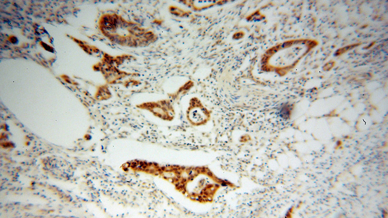 Immunohistochemical of paraffin-embedded human colon cancer using Catalog No:114121(PPFIBP1 antibody) at dilution of 1:100 (under 10x lens)