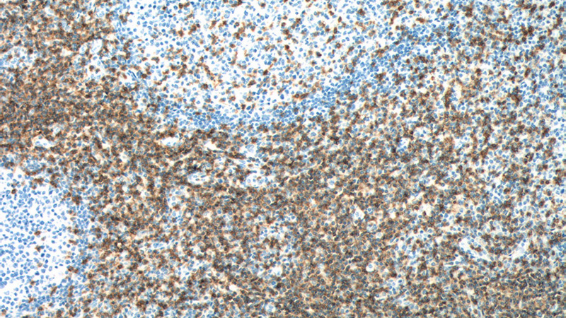 Immunohistochemistry of paraffin-embedded human tonsillitis tissue slide using Catalog No:109015(CD247 Antibody) at dilution of 1:200 (under 10x lens).