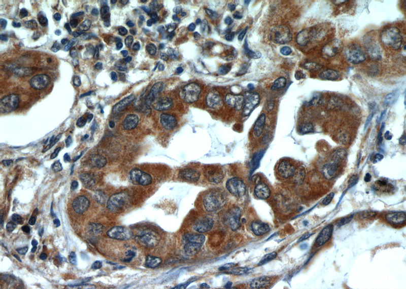 Immunohistochemical of paraffin-embedded human lung cancer using Catalog No:107985(ALKBH3 antibody) at dilution of 1:50 (under 40x lens)