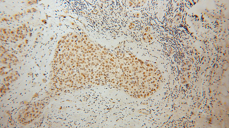 Immunohistochemical of paraffin-embedded human breast cancer using Catalog No:111065(GPKOW antibody) at dilution of 1:100 (under 10x lens)