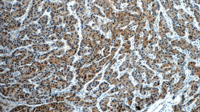 Immunohistochemistry of paraffin-embedded human liver cancer tissue slide using Catalog No:110799(FUT4 Antibody) at dilution of 1:100 (under 10x lens)