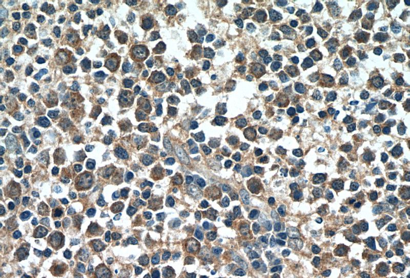 Immunohistochemistry of paraffin-embedded human tonsillitis tissue slide using Catalog No:113272(NRBF2 Antibody) at dilution of 1:50 (under 40x lens)