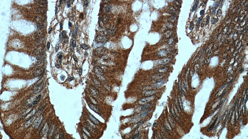 Immunohistochemical of paraffin-embedded human colon using Catalog No:114203(PRKG2 antibody) at dilution of 1:50 (under 40x lens)