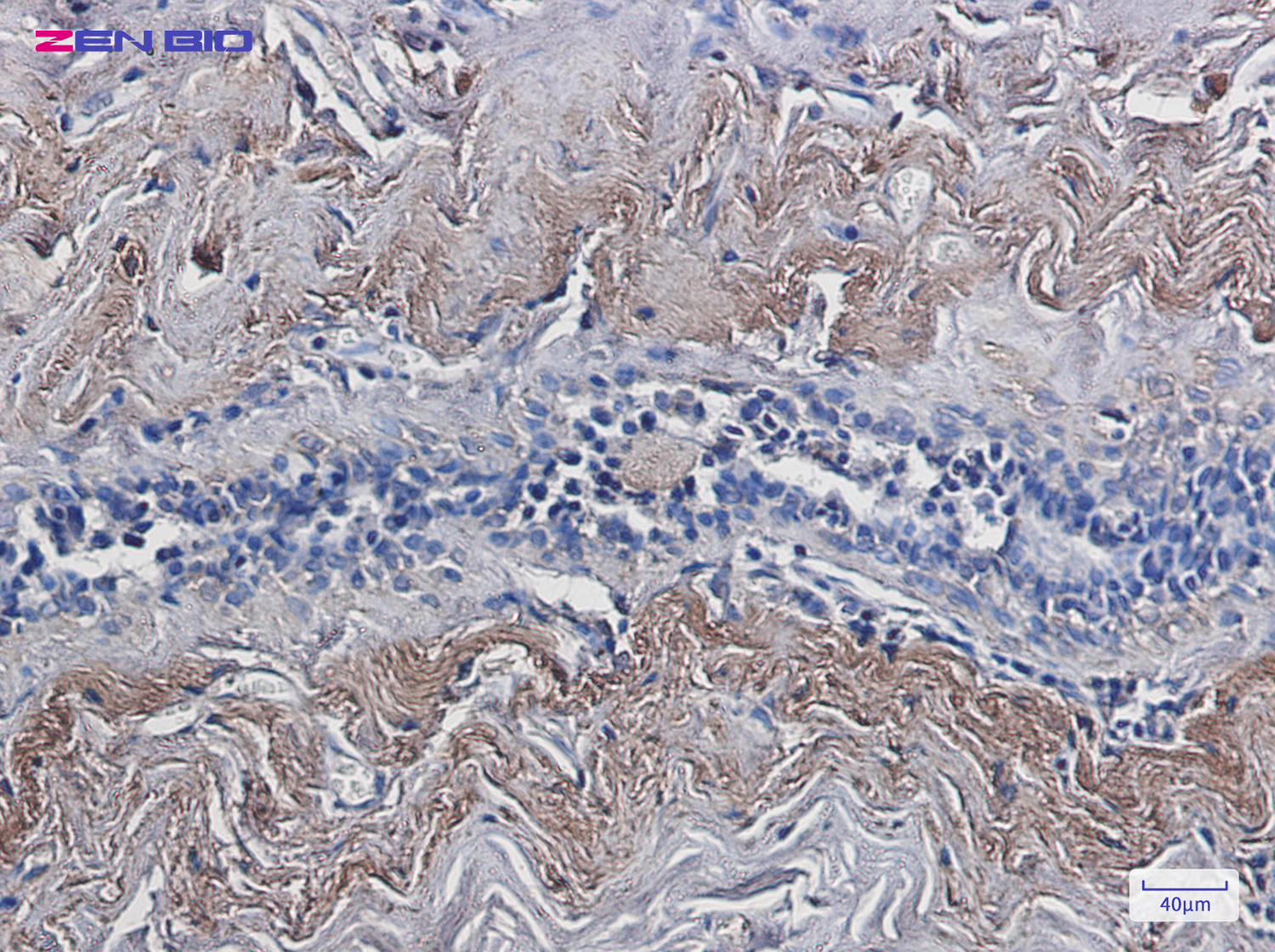 Immunohistochemistry of TXNL1 in paraffin-embedded Human breast cancer tissue using TXNL1 Rabbit pAb at dilution 1/20